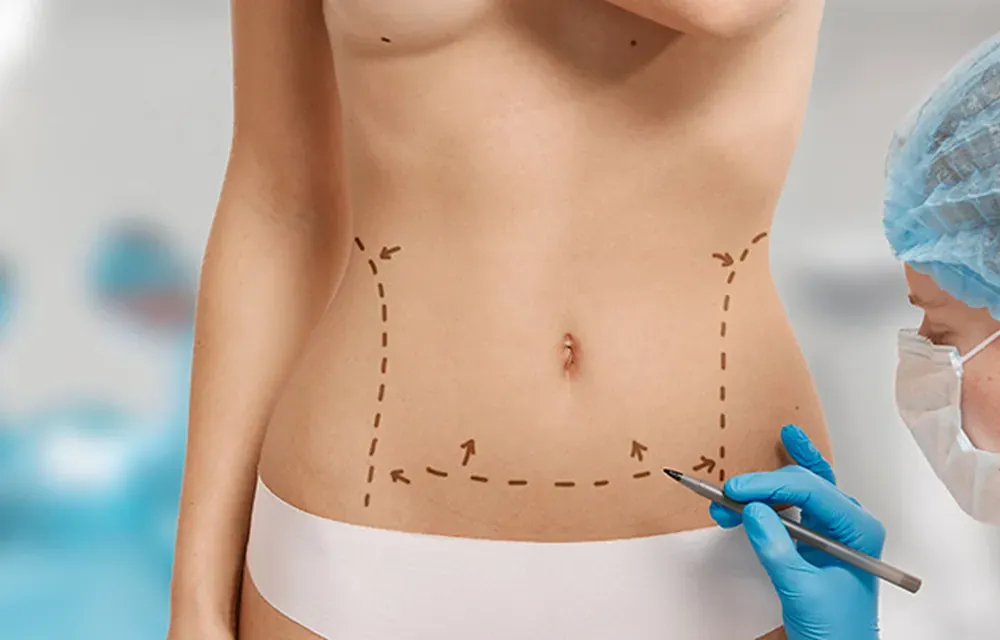 Marcação pré-operatória na região abdominal