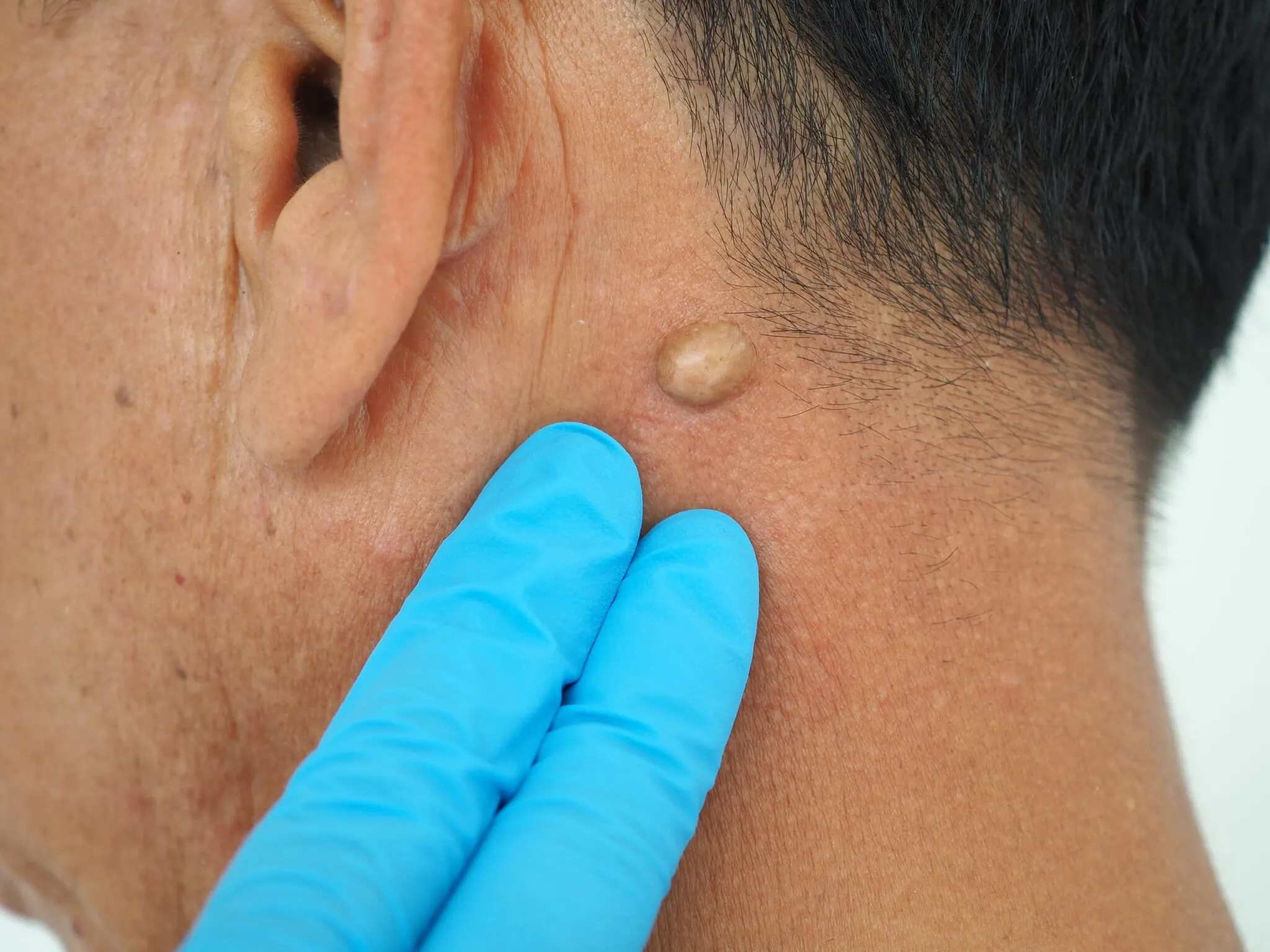 Exame de lesão de pele elevada no pescoço, com luva de procedimento