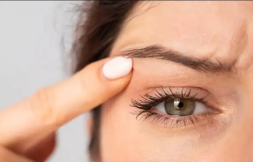 Sobrancelha caída, uma das queixas tratadas pelo lifting