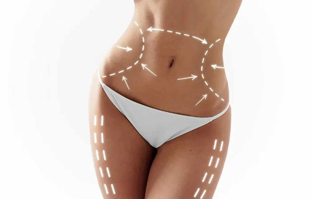 Marcação do contorno corporal para lipoescultura