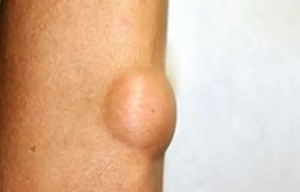 Lipoma sob a pele, avaliado antes da remoção